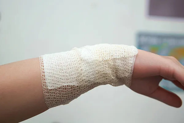 burn injury