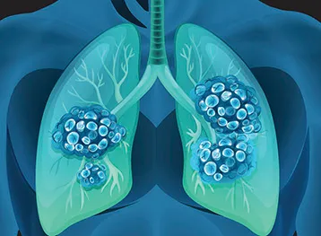 LTC Lung cancer research 358