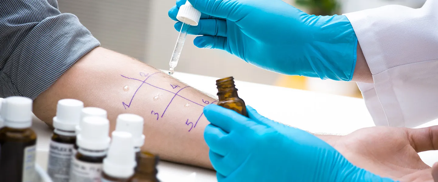 Close up of a doctor wearing blue gloves administering drops on a patient's arm for an allergy skin test