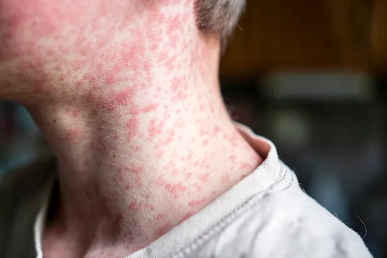 person with red bumps on face and neck.